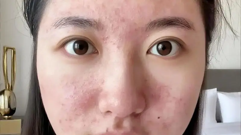 原创15岁女儿看皮肤却被开避孕药,妈妈怒气冲冲问为什么?医生的一番解释让妈妈羞惭不已,连连道谢