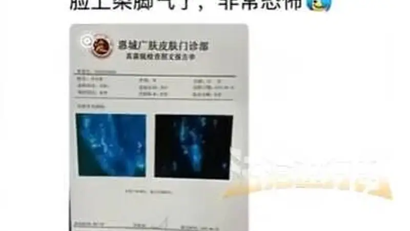 男子健身后脸上染“脚气”,多人曾中招:坐了一会儿,屁股就长了一片痘痘
